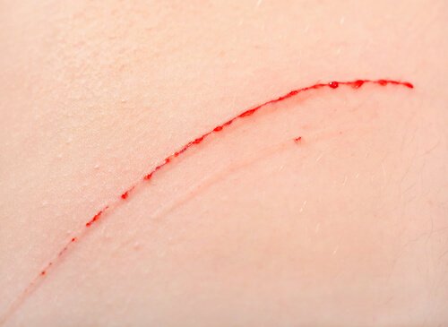 고양이할큄병의 증상